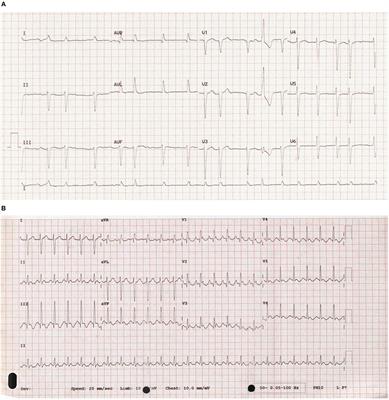 Arrhythmic Burden and Outcomes in Pulmonary Arterial Hypertension